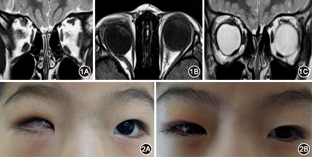 儿童后天进行性限制性斜视一例