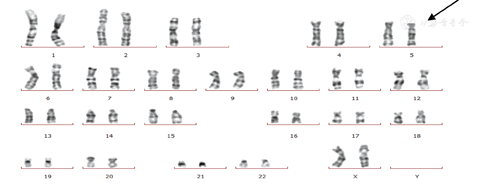 两例新生儿猫叫综合征报道