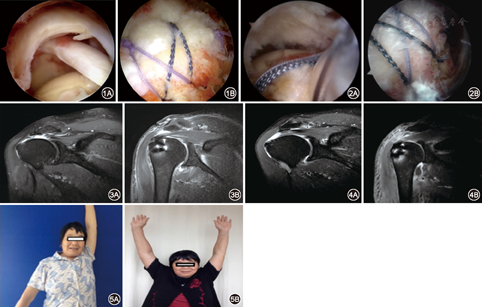 關節鏡治療老年巨大肩袖撕裂的療效分析