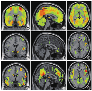 轻度认知障碍及阿尔茨海默病患者脑血流灌注与认知功能的回归分析 - 中华医学杂志