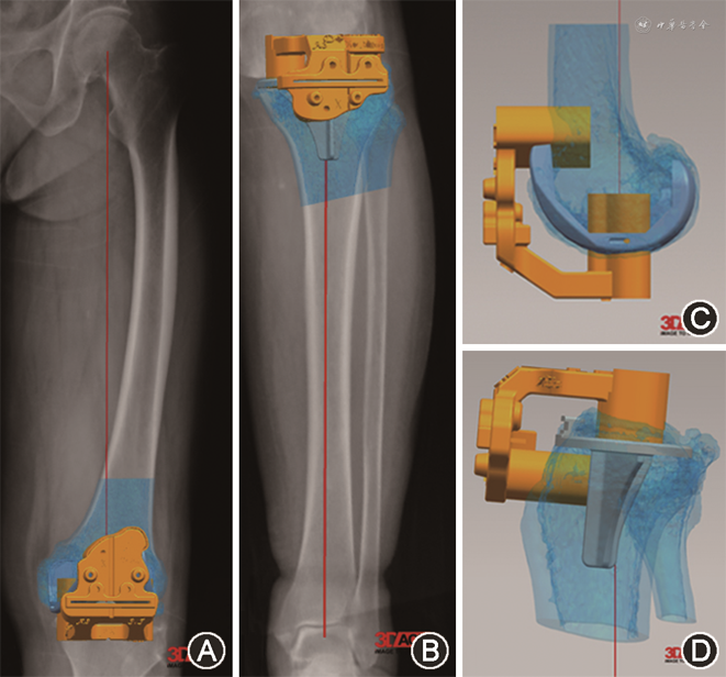 计算机导航辅助与个性化截骨导板在全膝关节置换术力线对准的比较