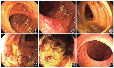 多學科團隊協作診治結腸多發潰瘍一例