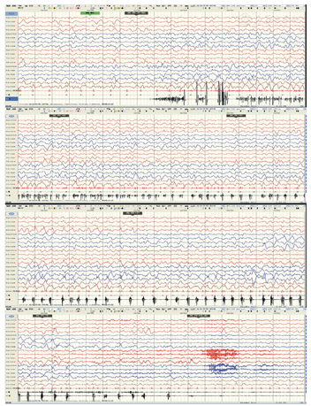 儿童rasmussen脑炎