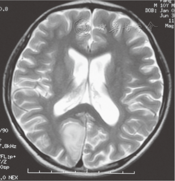 右侧枕叶病变 患儿第二次卒中样发作mri检查图像