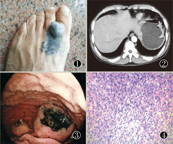 胃转移性恶性黑色素瘤一例