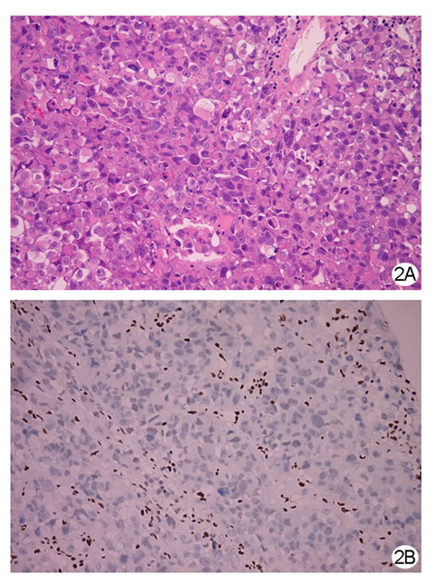 原发性SMARCA4缺失的胆囊肉瘤一例