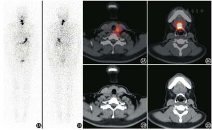 39分化型甲状腺癌术后131I显像中甲状舌管残留显影的思考 - 中华核医学与分子影像杂志
