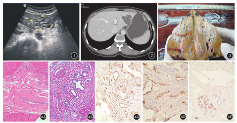成人肝脏间叶性错构瘤1例报道
