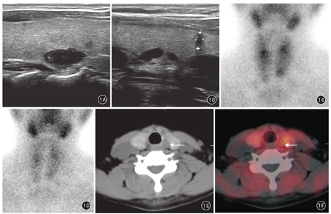 99Tcm-MIBI SPECT/CT在慢性肾病继发性甲状旁腺功能亢进定位诊断中的应用 - 中华解剖与临床杂志