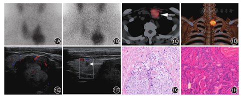 99Tcm-MIBI SPECT/CT显像联合超声检查在甲状旁腺功能亢进症合并甲状腺癌诊断中的应用 - 中华解剖与临床杂志