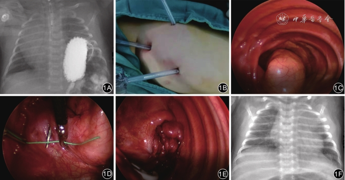 全胸腔镜手术治疗婴幼儿先天性膈疝的临床研究
