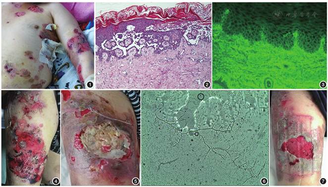 寻常型天疱疮合并近平滑念珠菌感染一例