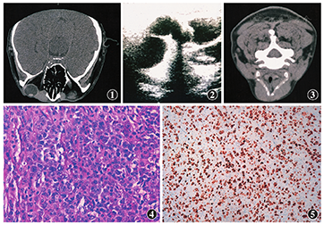 泪囊区弥漫大b细胞淋巴瘤一例