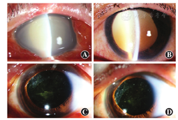 d结膜充血减轻,角膜水肿消退,可见角膜后细小灰白色沉着物,前房闪辉