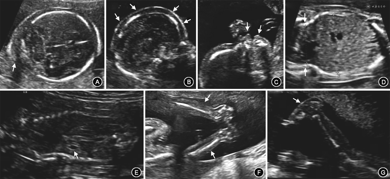 产前超声疑似胎儿运动不能畸形序列征引产后确诊1例