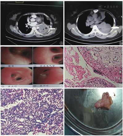 1例小细胞肺癌误诊为肺脓肿诊治分析