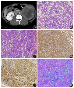 肾脏黏液样小管状和梭形细胞癌1例并文献复习