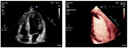 高频超声造影诊断左心室心尖部血栓1例 - 中国临床案例成果数据库