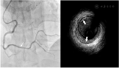 自发性冠状动脉夹层合并主动脉夹层1例 - 中国临床案例成果数据库
