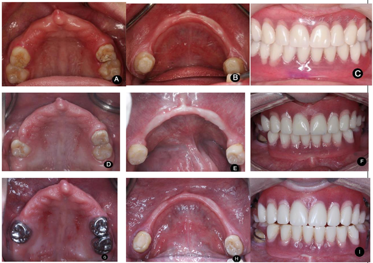 随访10年的全口覆盖义齿修复少汗型外胚叶发育不全综合征1例