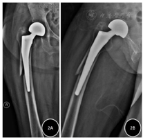 Vancouver B2型人工股骨头置换术后股骨假体周围骨折合并帕金森病行翻修 