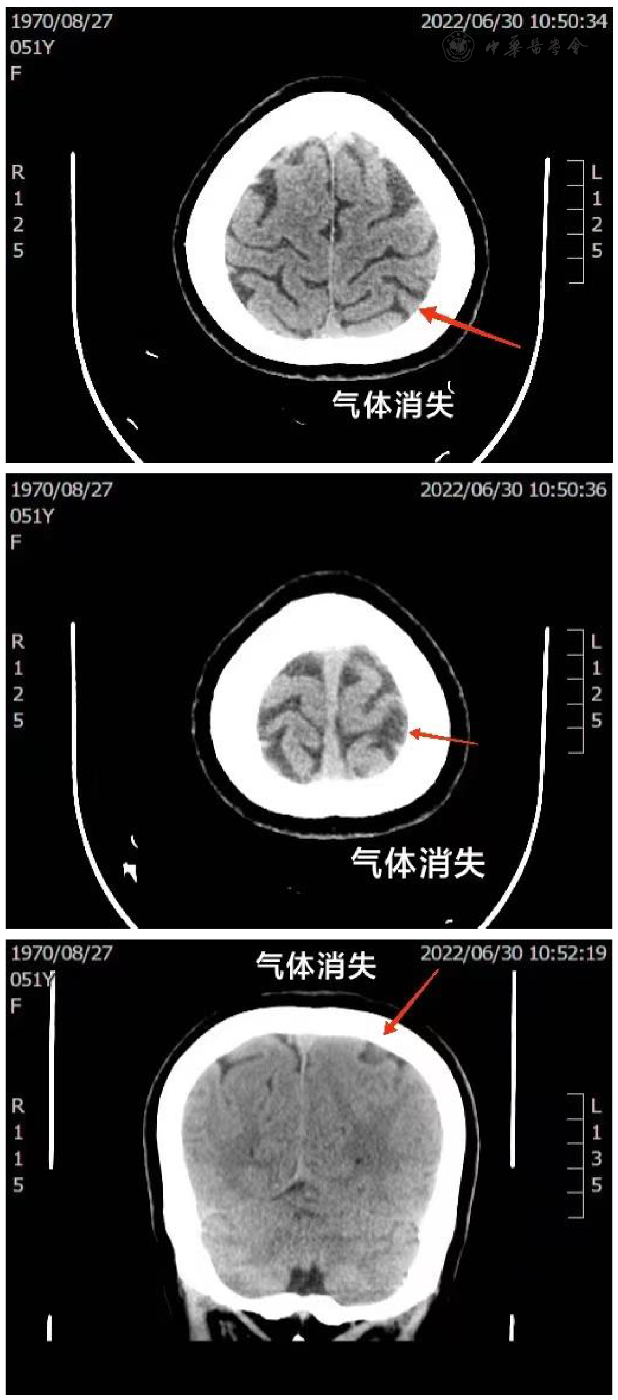 高压氧治疗脑空气栓塞1例