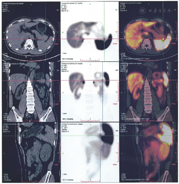 Ga68-PET/CT误诊胰腺实质内多发副脾为神经内分泌肿瘤1例 - 中国临床案例成果数据库