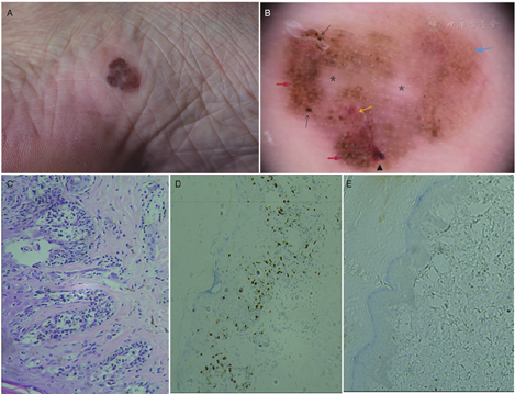 Dermoscopic Features Of Acral Lentiginous Melanoma In Situ