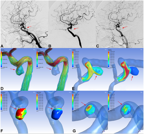 Hemodynamic analysis for endovascular treatment in small unruptured ...