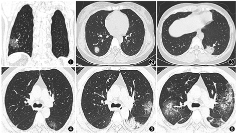 胸部CT筛查在新型冠状病毒肺炎暴发早期的价值