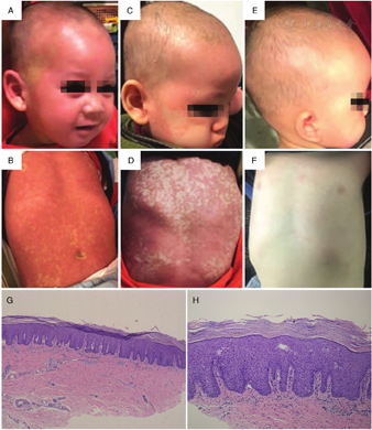 Successful Treatment of Severe Pityriasis Rubra Pilaris with ...