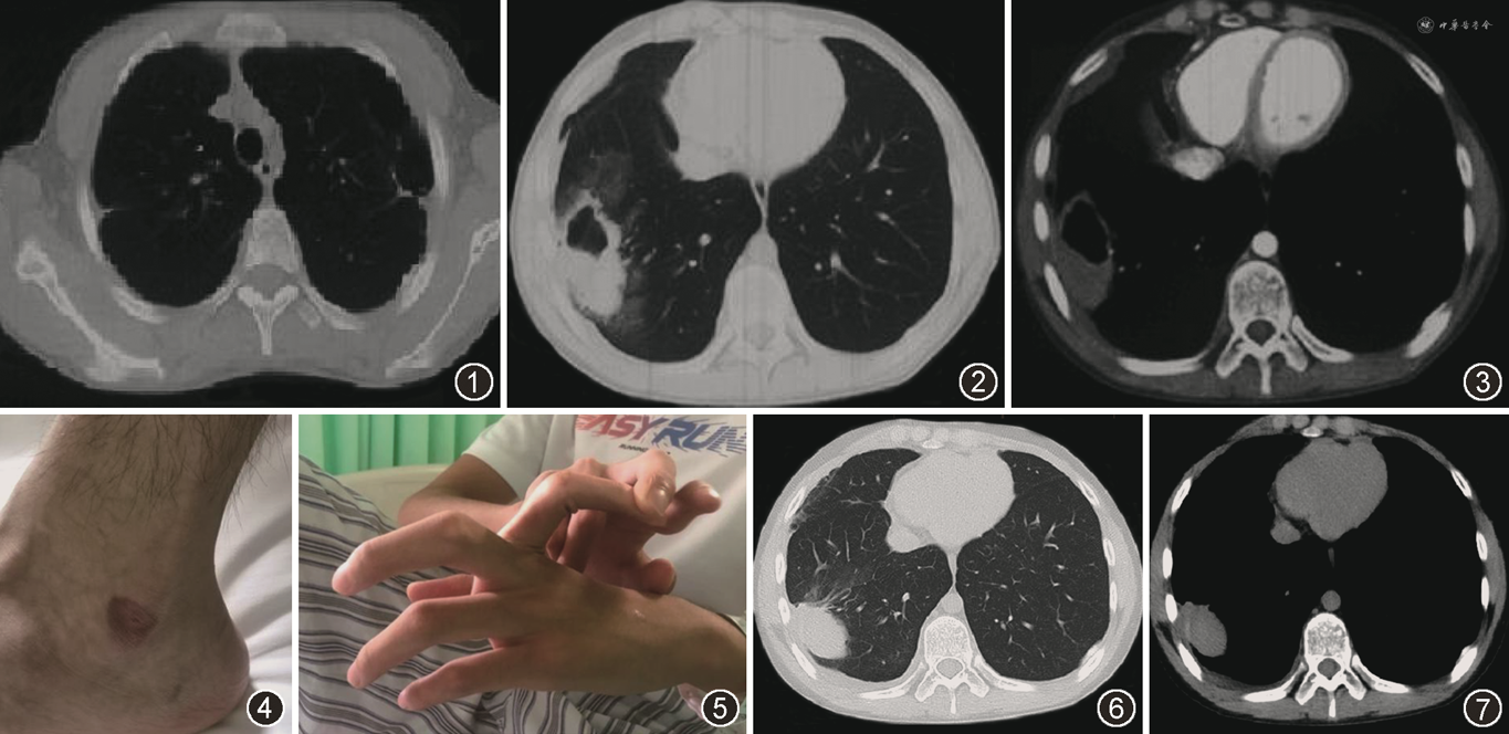 表现为反复气胸、咯血的血管型EhlersDanlos 综合征1例 中华结核和呼吸杂志