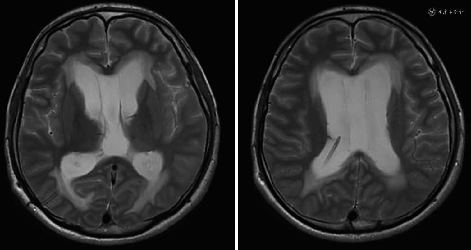以情绪低落症状起病的松果体肿瘤术后梗阻性脑积水1例 - 中华精神科杂志