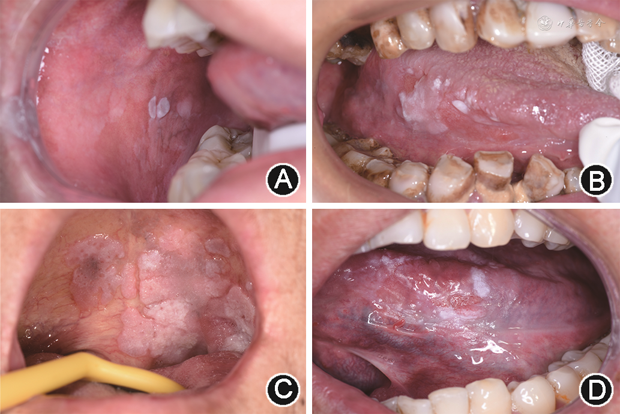 口腔白斑病的规范性临床诊疗