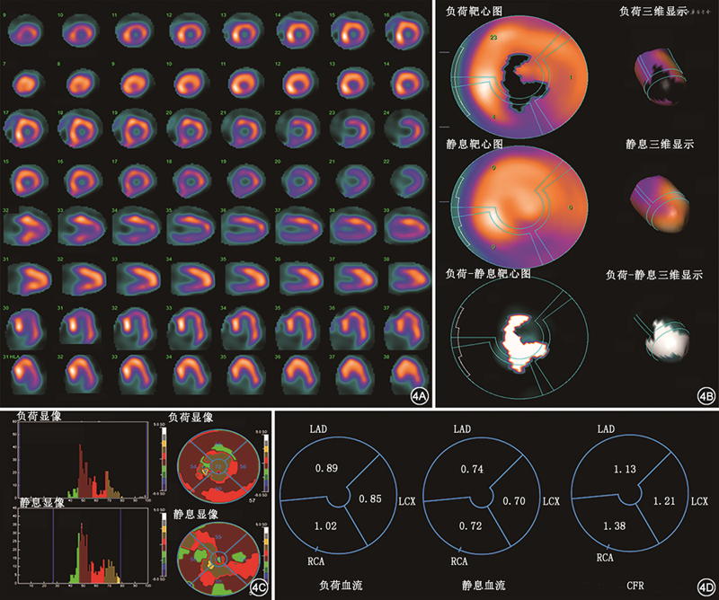 CZT-SPECT动态心肌血流定量显像诊断肥厚型心肌病伴微血管功能障碍1例 - 中华心血管病杂志