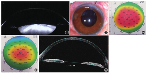 双眼年龄相关性白内障合并球形角膜手术治疗一例