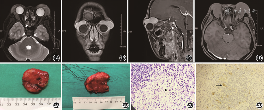 眼眶泪腺区Rosai-Dorfman病1例
