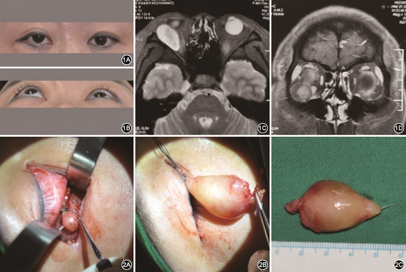 起源于动眼神经支配下斜肌分支的神经鞘瘤2例