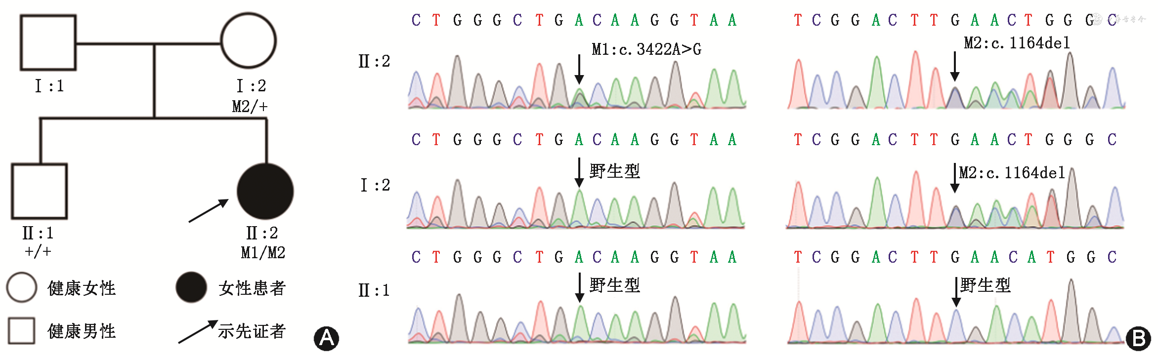 PNPLA6基因变异导致的Oliver-McFarlane综合征1例