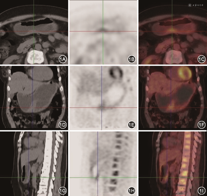 乳腺浸润性导管癌胃转移18F-FDG PET-CT显像1例报道 - 中华转移性肿瘤杂志